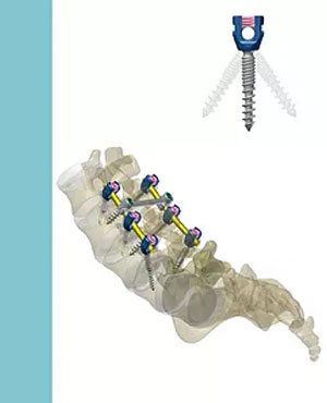 Instrumentación de columna lumbar